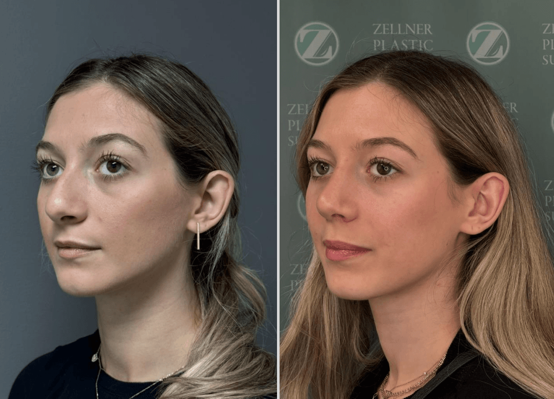 001 - Rhinoplasty