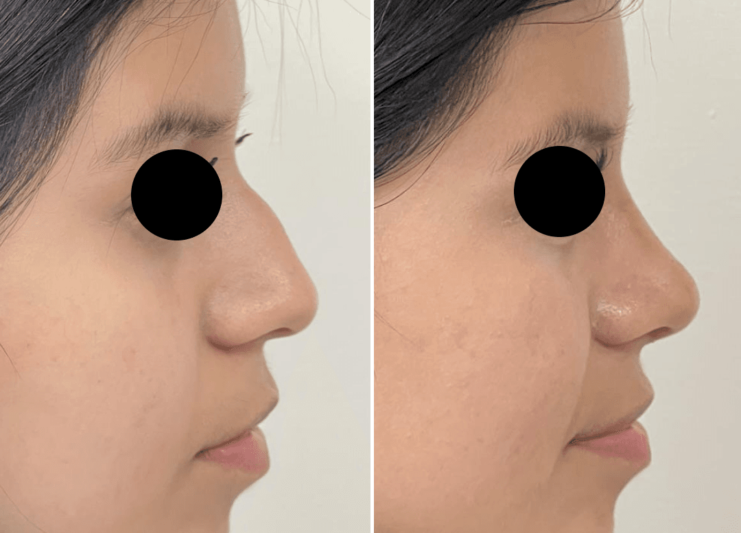 002 - Rhinoplasty