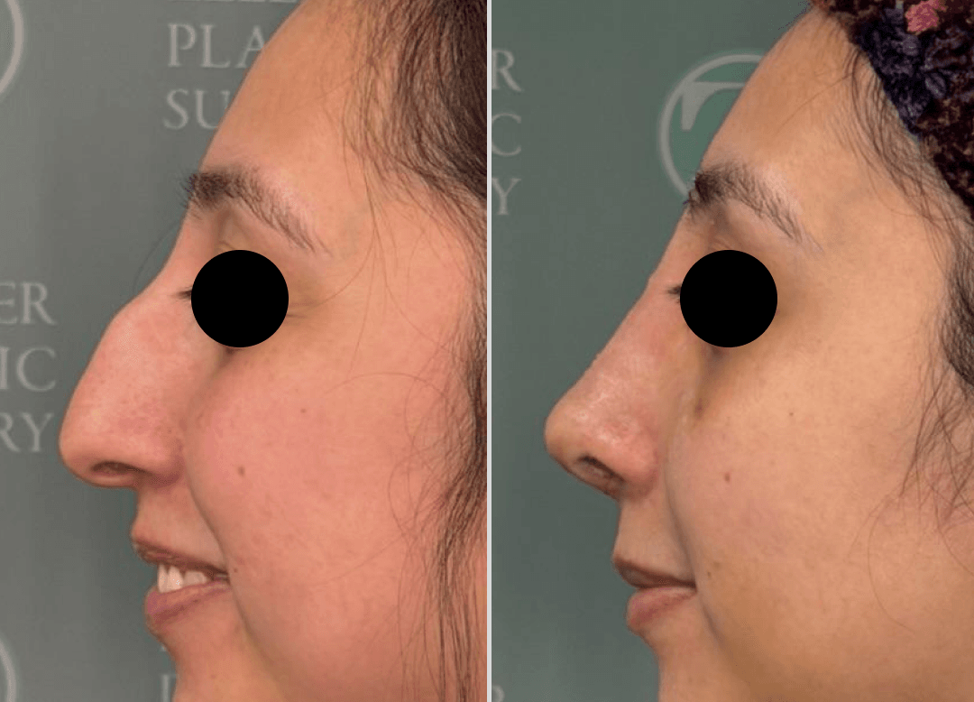 003 - Rhinoplasty