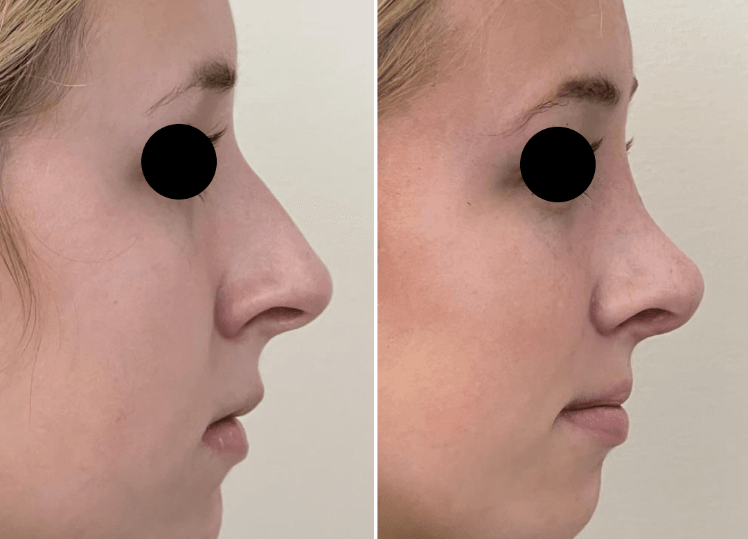 004 - Rhinoplasty