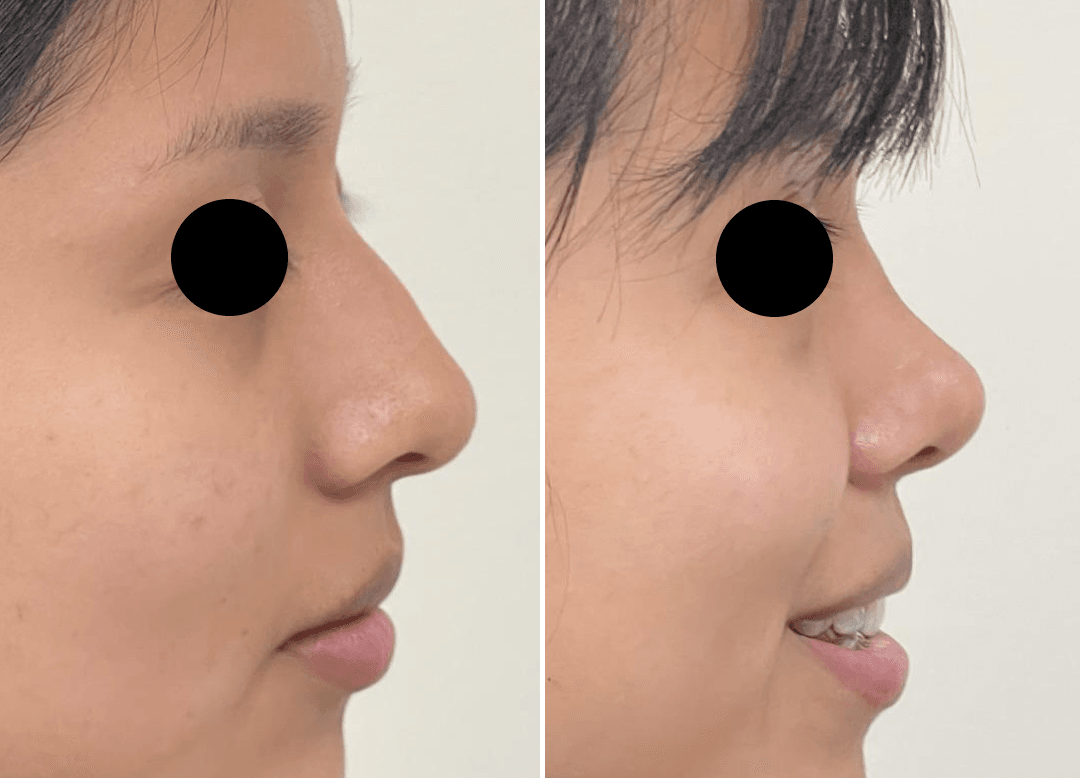 005 - Rhinoplasty