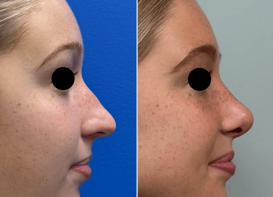 006 - Rhinoplasty