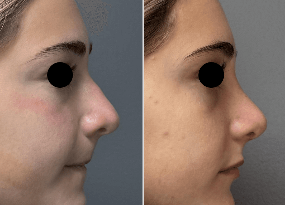 007 - Rhinoplasty