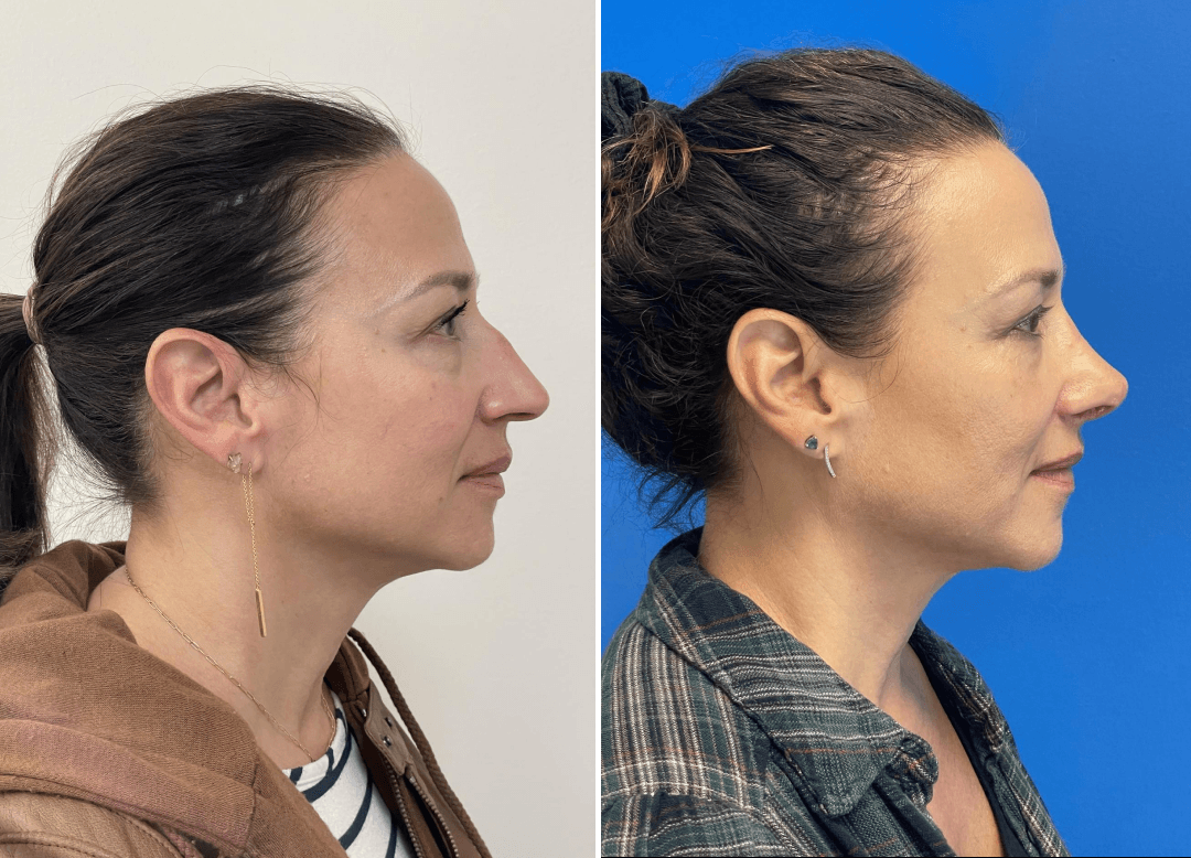 008 - Rhinoplasty